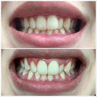 Dentalobrace™- Dİş Hizalama Seti